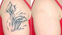 Best Laser Tattoo Removal in Melbourne image 3